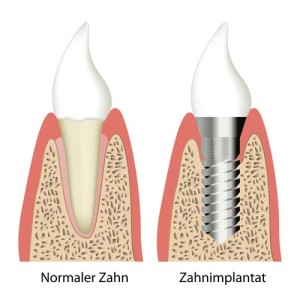 Ihr Zahnarzt für Implantate in Heroldsberg